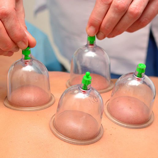 hijama cupping