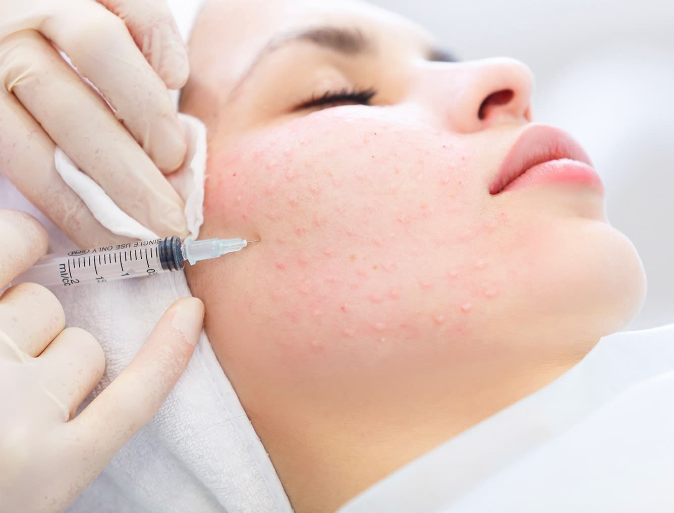 mesotherapie centre champs mars