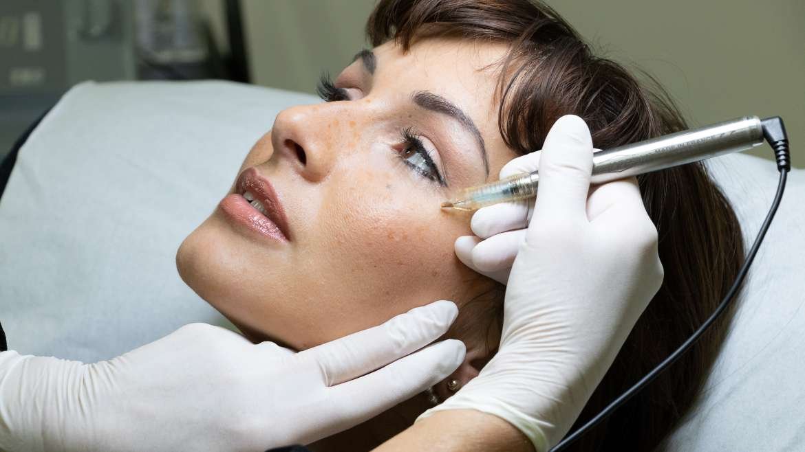 prestation taches rousseur 1170x658